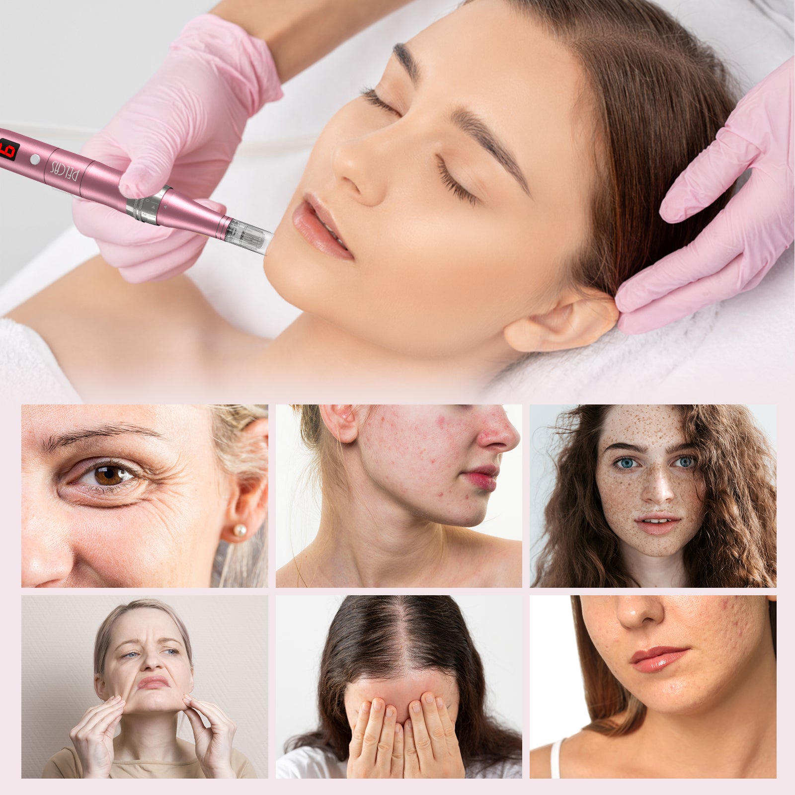 PELCAS Cordless Microneedling Pen