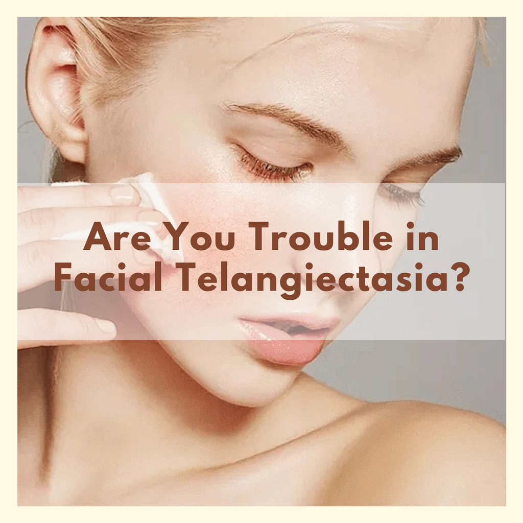Are You Trouble in Facial Telangiectasia?
