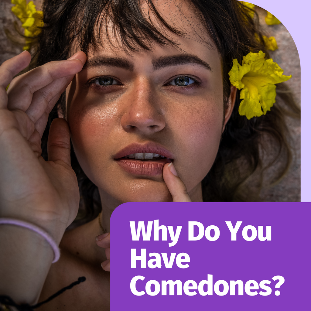 Why Do You Have Comedones?