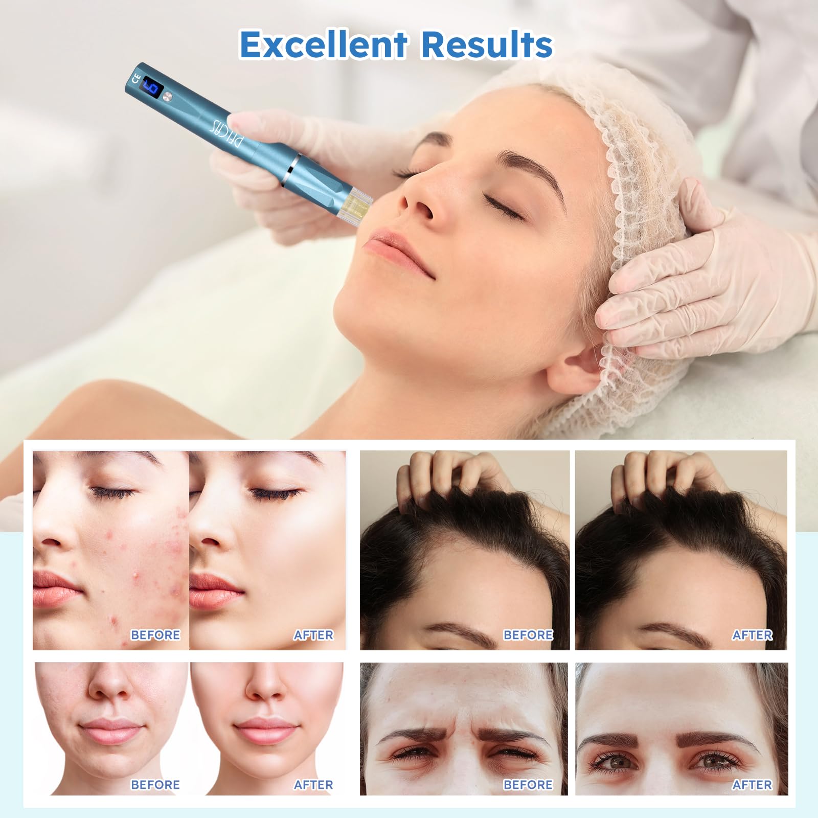 PELCAS Automatic Serum Applicator Microneedling Pen